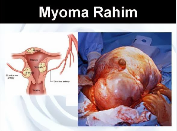 Penyebab Miom Pada Wanita Dewasa Penyebab Miom Pada Wanita Dewasa